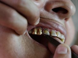 Especialistas resaltaron que la clave para evitar estos problemas es atender la salud dental desde la infancia, lo que evitará que en la edad adulta haya problemas. AP / ARCHIVO